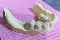 インプラント歯型